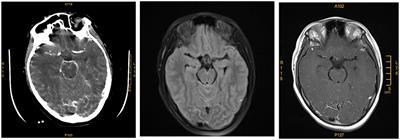 Case Report and Literature Review: Bacterial Meningoencephalitis or Not? Naegleria fowleri Related Primary Amoebic Meningoencephalitis in China